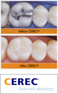before and after CEREC same day crowns procedure at Oceanside restorative dentistry