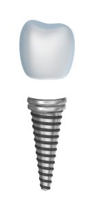 A graphic image of a dental implant top and base.