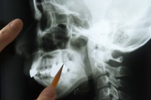 A jawbone X-ray being examined in an emergency dental exam in Oceanside.