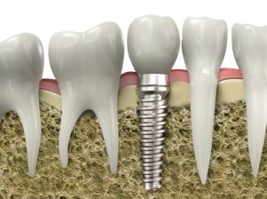 A graphic image of a dental implant placed by restorative dentist in Oceanside.