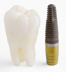 A lost tooth from untreated gum disease and a dental implant.