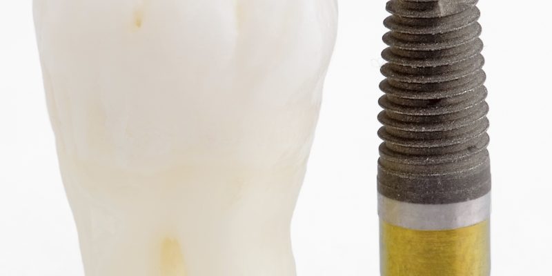 A lost tooth from untreated gum disease and a dental implant.